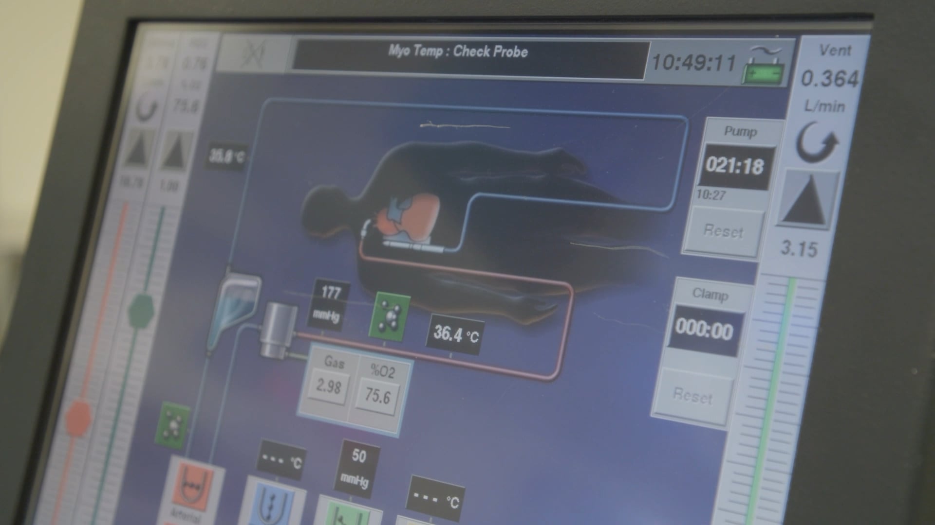 caption-a-monitoring-screen-that-tracks-blood-flow-oxygen-levels-and-temperature-while-an-artificial-lung-system-temporarily-replaces-the-lungs-function-after-surgeons-removed-a-patients-lungs-credi